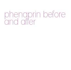 phenaprin before and after