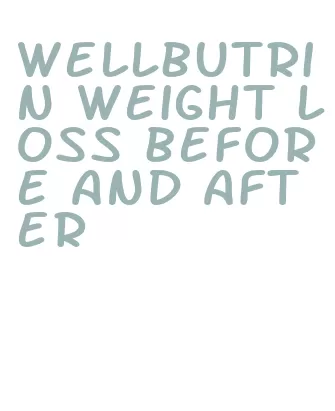 wellbutrin weight loss before and after