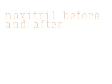noxitril before and after